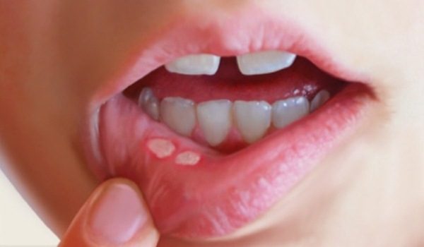 Farmacia 3.0 – afte in bocca, cause e rimedi