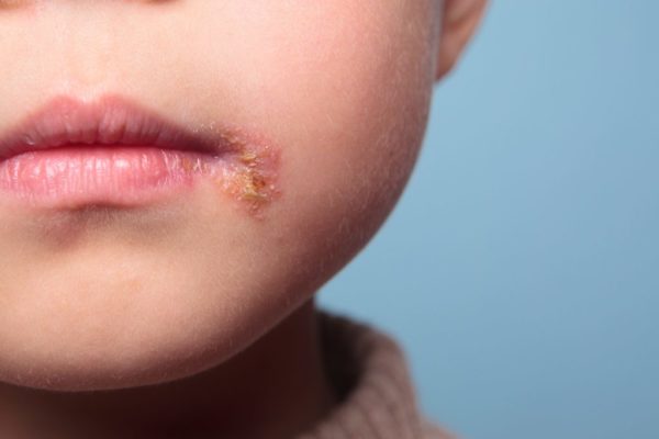 Farmacia 3.0 – l’omeopatia è utile per l’herpes labiale