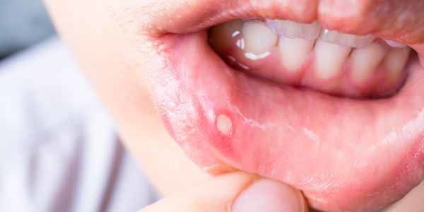 Farmacia 3.0 – Mi brucia la lingua: ho la stomatite?