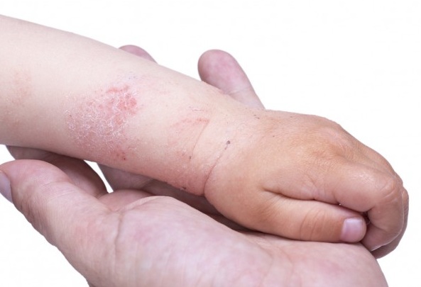 Farmacia 3.0 – La dermatite atopica nei bambini e la soluzione omeopatica
