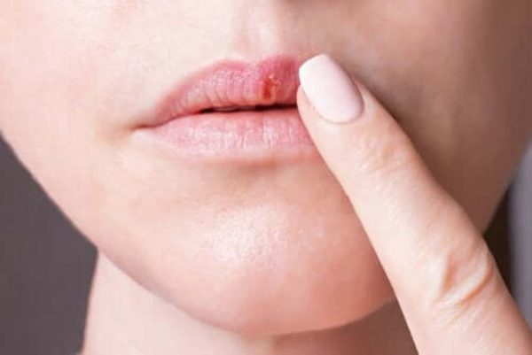 Farmacia 3.0 – i rimedi naturali per combattere l’herpes labiale