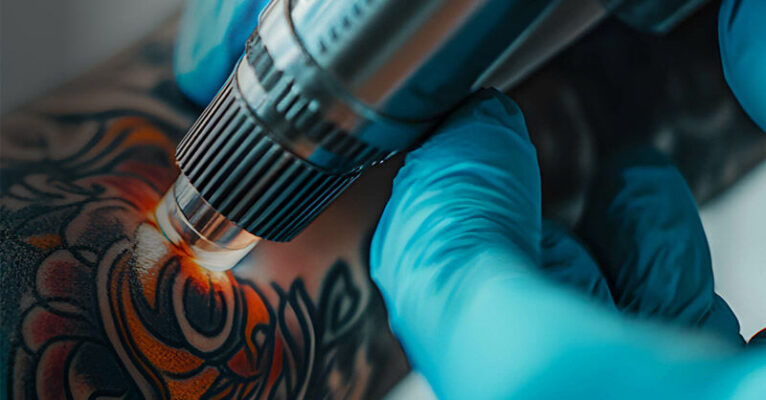 aura rimozione tatuaggi aprile 26 fb